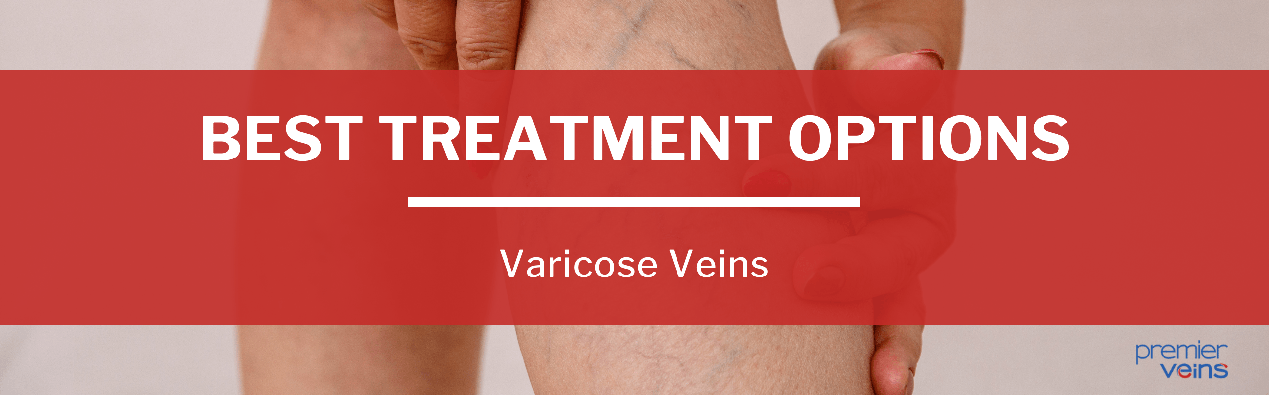 Best varicose vein treatment options