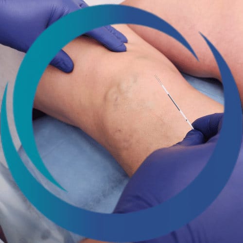 close up of varicose veins on a leg