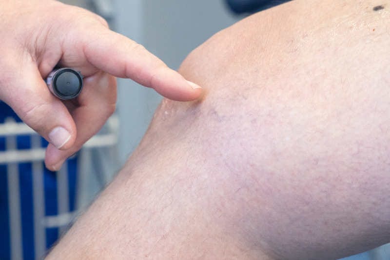 Surgeon pointing to thread veins on a leg