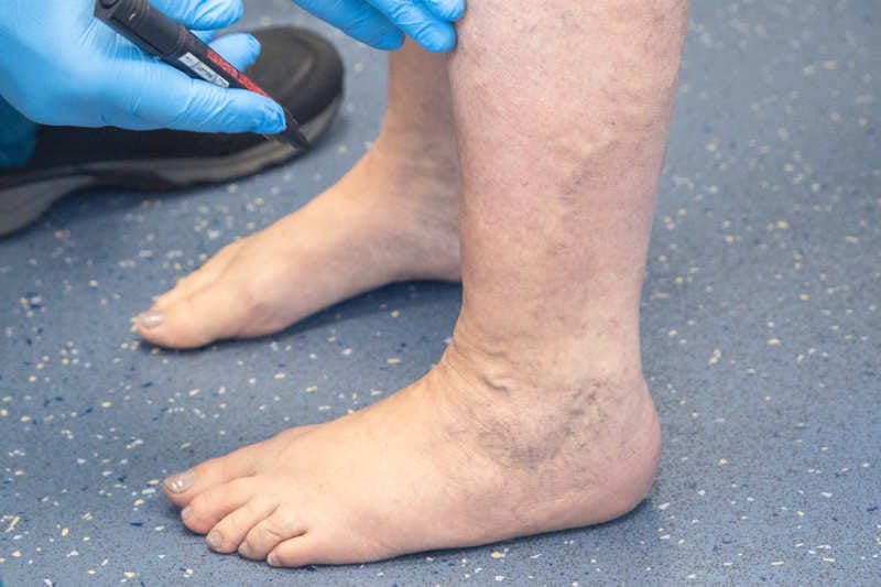 surgeon marking varicose veins