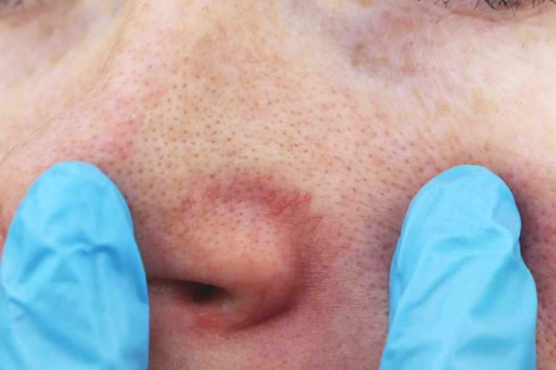 Small thread veins around a patient's nostril